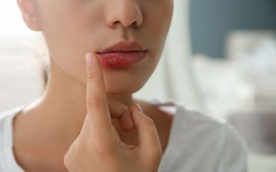 Cold Sores: A Natural Remedy with Essential Oils