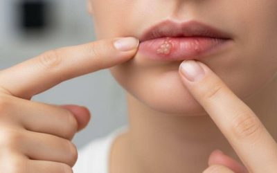 Cold Sores Natural Remedy: Heal Faster with Essential Oils